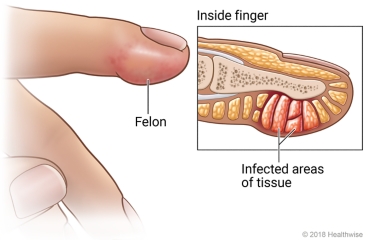 Felon on pad of fingertip, with detail of inside finger showing infected areas of tissue
