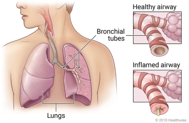 Lungs in chest showing bronchial tubes in left lung, with detail of healthy airway and airway inflamed by chronic bronchitis