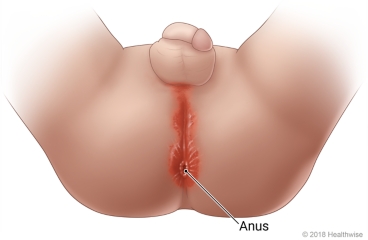 Child with legs spread wide, showing bright red rash around anus and up to genital area