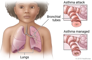 Lungs in child's chest showing bronchial tubes, with detail showing narrowed tube in asthma attack and partly opened tube in managed asthma