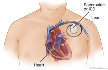 Inside view of heart in chest, with placement of pacemaker or ICD nearby and lead from device through blood vessel to inside of heart