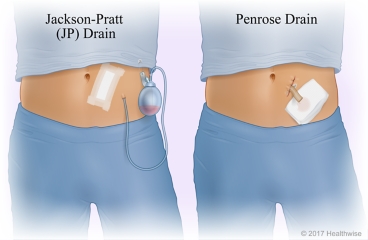 Surgical drain tube with bulb on the end and surgical drain tube that is open to dressing