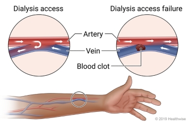 Location of a hemodialysis access in an arm, with close-ups of a common type of access and an example of access failure