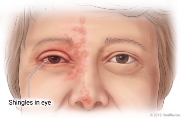 Shingles in the eye, with rash on nose and forehead