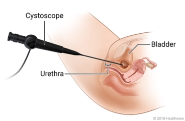 Cystoscope placement through urethra into bladder