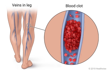Location of deep veins in the legs, with detail of blood clot in vein