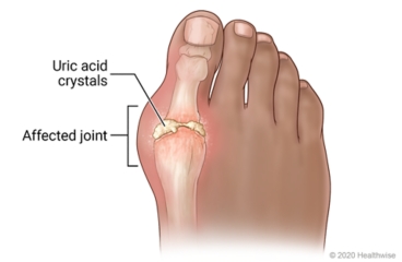 Gout in joint at base of big toe, showing uric acid crystals causing swelling and redness