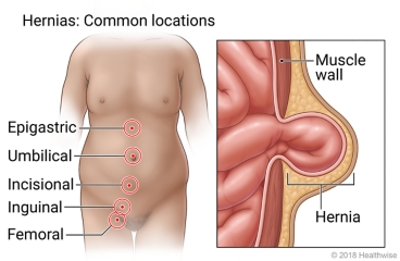 Common locations of hernias, showing epigastric below chest, umbilical at belly button, incisional at surgical incision site, inguinal at groin, and femoral at upper leg, with inside view of intestine protruding from hole in muscle wall