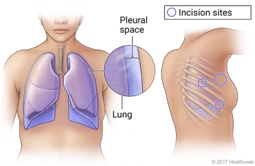 Lungs in chest showing pleural space, and possible incision sites between ribs on person's side for thoracoscopy.