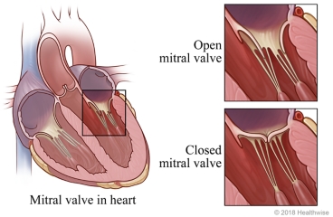 Inside view of heart showing location of mitral valve between two chambers of the heart, with detail of open valve and closed valve