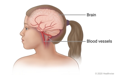 Child's head, showing brain and blood vessels in brain and leading into brain
