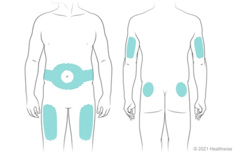 Locations on body for giving insulin shots, including on belly around navel, thighs, back of upper arms, and upper buttocks.