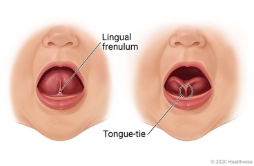 Child's open mouth, showing normal lingual frenulum with tongue raised up and a short lingual frenulum holding tongue down.