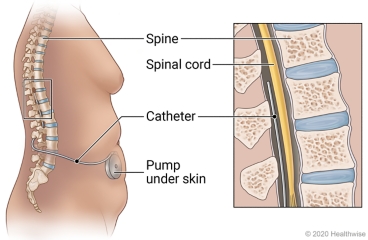 Location of catheter and pump under skin of the belly, with detail of spine, spinal cord, and placement of catheter