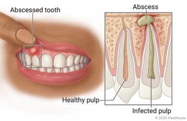 Mouth with abscessed tooth and pocket of pus in gums near it, with inside detail of tooth with healthy pulp and abscessed tooth with infected pulp