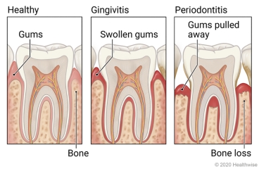 Showing progression of gum disease, with detail of healthy tooth, of gingivitis and swollen gums, and of periodontitis with gums pulled away and bone loss.