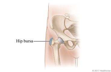 Location of the bursa at the outside of the hip.