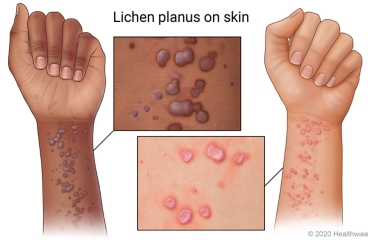 Lichen planus on skin on underside of wrist, with close-up of rash.