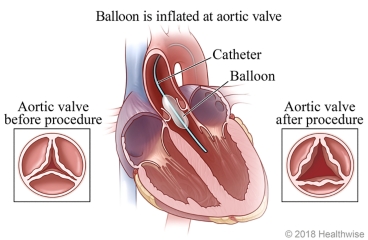 Balloon valvuloplasty, showing location of the balloon in the heart and the difference between the aortic valve before valvuloplasty and after the procedure