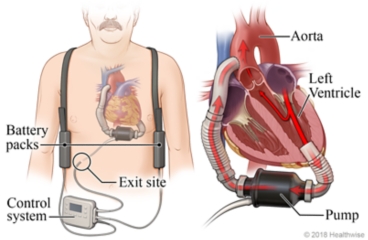 Location of VAD pump, battery packs, and controller, with detail of VAD pumping blood from the heart's left ventricle to the aorta.