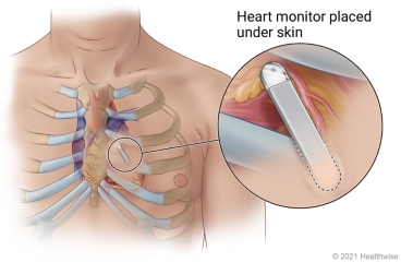 Heart monitor placed under skin in chest near sternum, with detail of monitor in place.