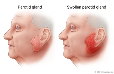 Location of parotid gland close to ear, showing healthy parotid gland and red and swollen parotid gland.