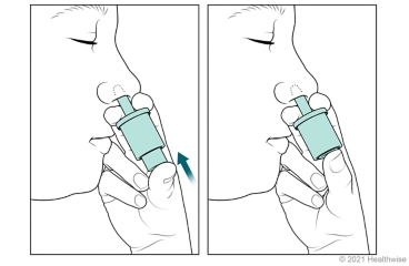 Push the plunger to deliver a single dose of glucagon nasal spray.