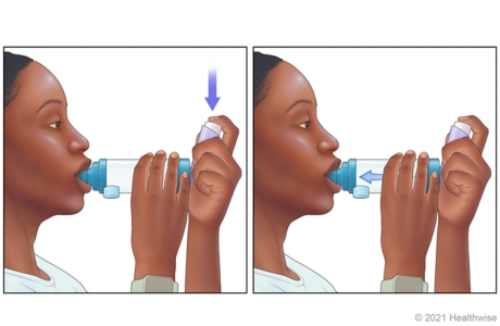 Person pressing down on inhaler to release medicine into spacer, then breathing in.