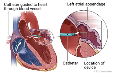 Inside view of heart with catheter guided to heart through blood vessel, and detail of left atrial appendage, catheter, and location of device.