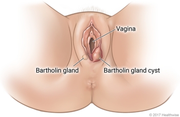 External female genital area, showing Bartholin gland on one side and swollen gland cyst on other side of vagina opening.
