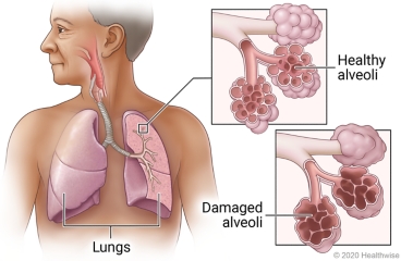 Lungs in chest, showing airways of a lung with detail of healthy alveoli and damaged alveoli.