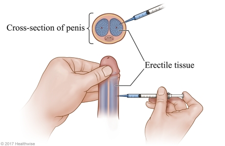 Injecting medicine into the side of the penis at a 90-degree angle.