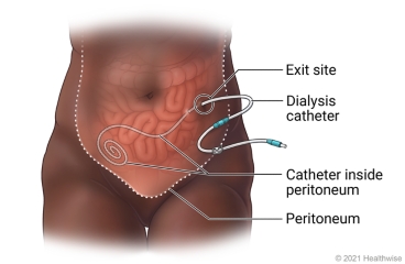 Location of dialysis catheter outside the body and inside peritoneum.