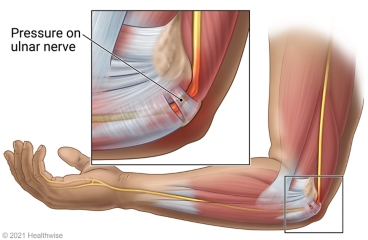 Ulnar nerve passing through tunnel at the elbow, with detail of pressure on the nerve.
