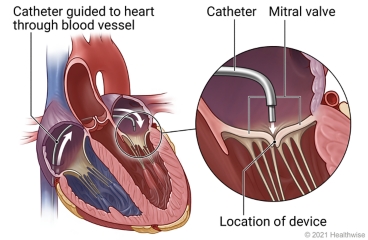 Inside view of heart showing path of catheter through blood vessel, with detail of mitral valve, catheter, and location of device at valve.