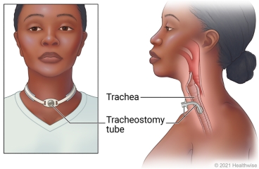 Front view of tracheostomy tube in neck with inside view of tracheostomy tube inserted into trachea.