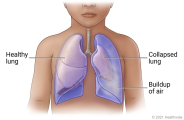 Lungs in child's chest, showing healthy lung and collapsed lung.