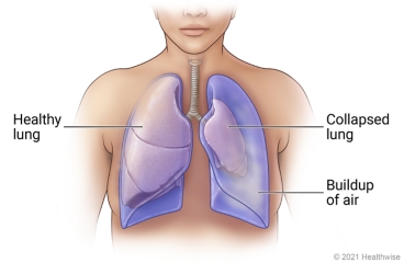 Lungs in chest, showing healthy lung and collapsed lung.