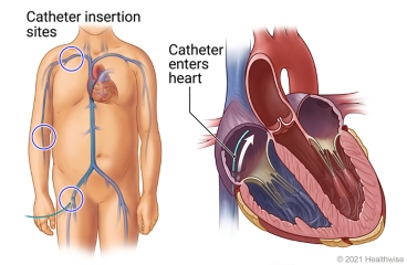 Location of catheter insertion sites on the body, with detail of catheter entering heart.