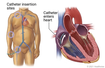 Location of catheter insertion sites on the body, with detail of catheter entering heart.