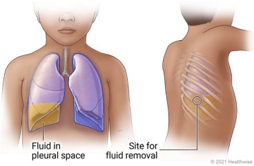 Lungs in child's chest showing fluid in right pleural space, and view of back showing site between two ribs for fluid removal.