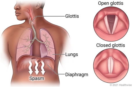 Glottis in throat and lungs in chest above diaphragm, showing diaphragm spasm that causes hiccups, with detail of open glottis and closed glottis.