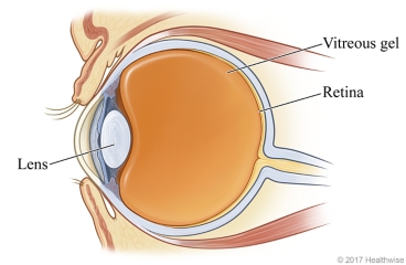 Cross-section of healthy eye, showing the lens, vitreous gel, and retina.