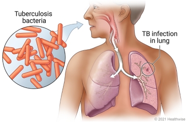 Person breathing tuberculosis bacteria in from air into lungs, showing TB infection in lung.