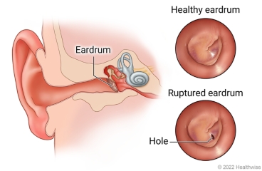 Parts of the ear showing eardrum inside ear, with detail of healthy eardrum and hole in ruptured eardrum.