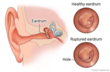 Parts of the ear showing eardrum inside ear, with detail of healthy eardrum and hole in ruptured eardrum.