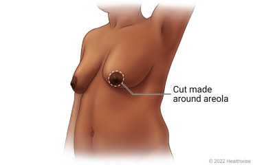 Learning About Breast Cancer Surgery