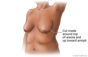 Nipple Sparing Mastectomy