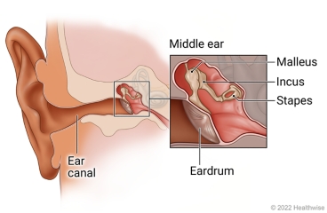 Inside view of ear, showing ear canal and middle ear with detail of ear drum and bones of middle ear (malleus, incus, and stapes).