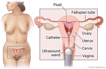 Female reproductive system (vagina, cervix, uterus, ovaries, and fallopian tubes), showing ultrasound wand in vagina and fluid going through catheter into uterus.